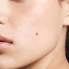 Điểu trị mụn cóc, mụn ruồi, ghẻ,…