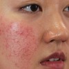 Điều trị da viêm, đỏ ngứa, sần sùi, không đều màu.