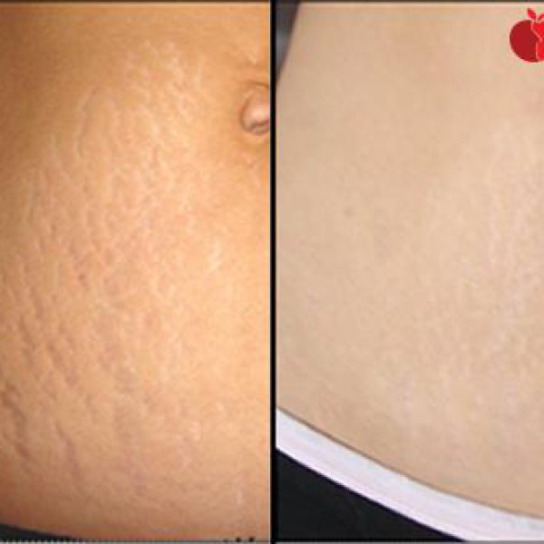ĐIỀU TRỊ RẠN DA