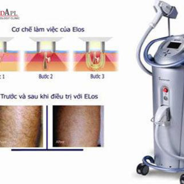 TRIỆT LÔNG VĨNH VIỄN