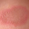 Điều trị Chàm, vảy nến, mề day,…