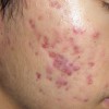 Điều trị mụn, da nhờn, thâm, sẹo...