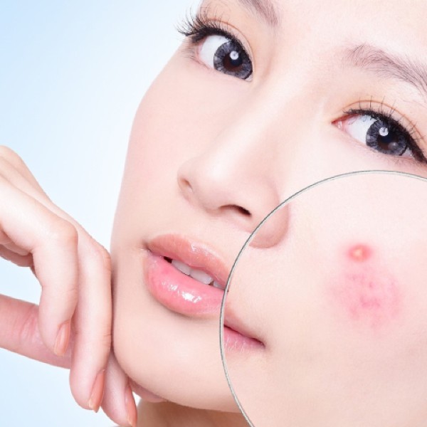 Cách để hết mụn trứng cá và duy trì làn da khỏe mạnh