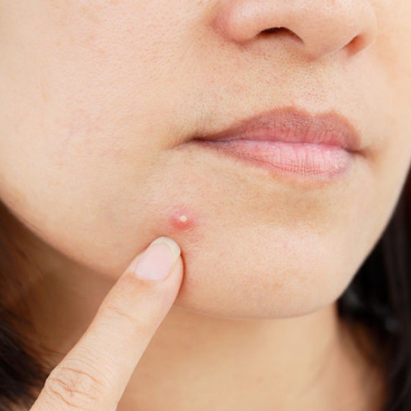Cách hết mụn trứng cá nhẹ bằng phương pháp thiên nhiên tại nhà