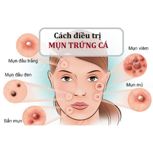 CÁCH ĐIỀU TRỊ MỤN TRỨNG CÁ HIỆU QUẢ NHẤT