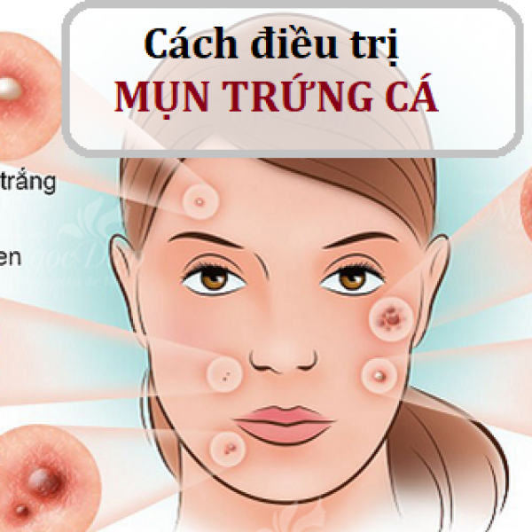 CÁCH ĐIỀU TRỊ MỤN TRỨNG CÁ HIỆU QUẢ NHẤT