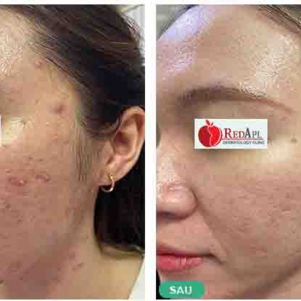 Hiểu đúng về mụn trứng cá, nguyên nhân và cách điều trị | Phòng Khám Da Liễu Táo Đỏ