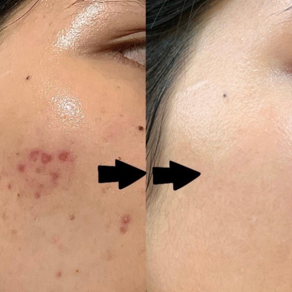 Các loại thuốc điều trị mụn trứng cá hiệu quả từ nhẹ đến nặng