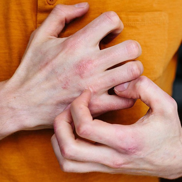 Lichen phẳng ở tay - Triệu chứng, nguyên nhân và cách điều trị