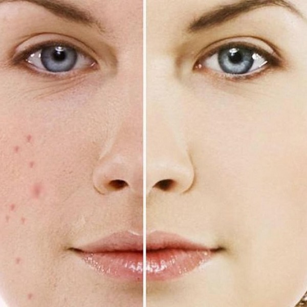 Mật ong trị thâm sẹo được không? Các lợi ích của mật ong với da là gì?