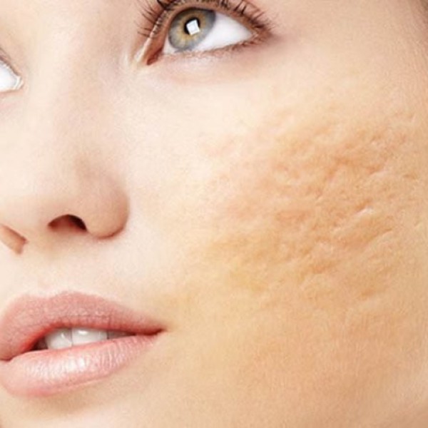 Các loại serum trị sẹo rỗ bác sĩ da liễu khuyên dùng