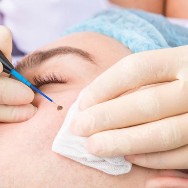 Tẩy nốt ruồi ở phòng khám da liễu an toàn, không để lại sẹo 