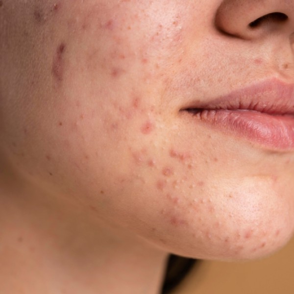 Top 5 thuốc trị mụn của bác sĩ da liễu khuyên dùng