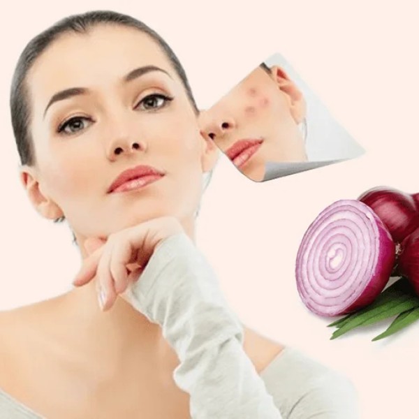 Công thức trị sẹo thâm bằng hành tím đơn giản và hiệu quả