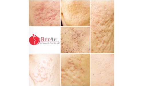 ĐIỀU TRỊ SẸO BẰNG LASER