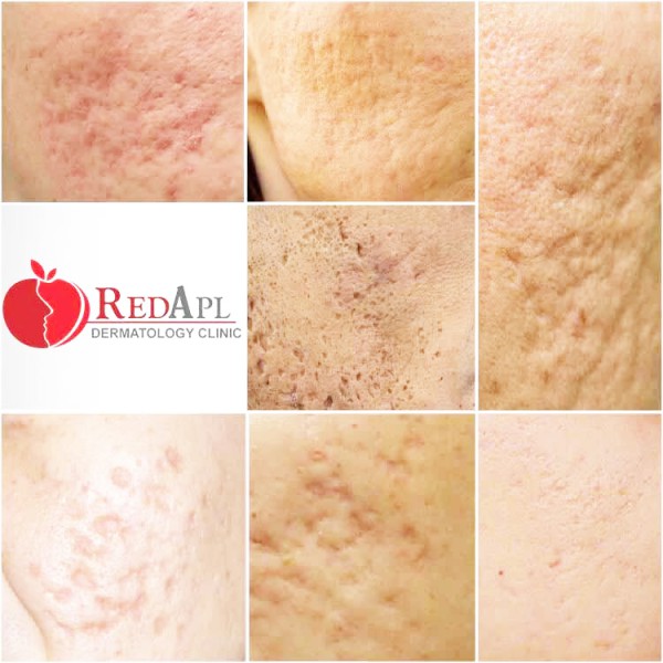 ĐIỀU TRỊ SẸO BẰNG LASER