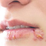 Bệnh Herpes