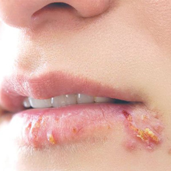 NHIỄM HERPES SIMPLEX DA NIÊM