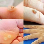Mụn Cóc