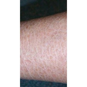 Bệnh da vảy cá