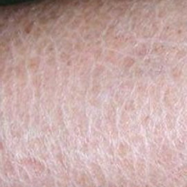 Bệnh da vảy cá