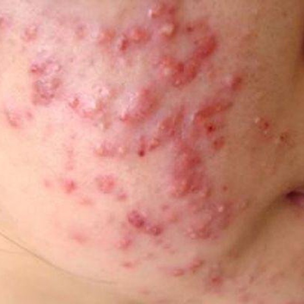 Mụn trứng cá