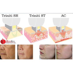 TRẺ HÓA DA, XÓA NẾP NHĂN BẰNG CÔNG NGHỆ ELOS