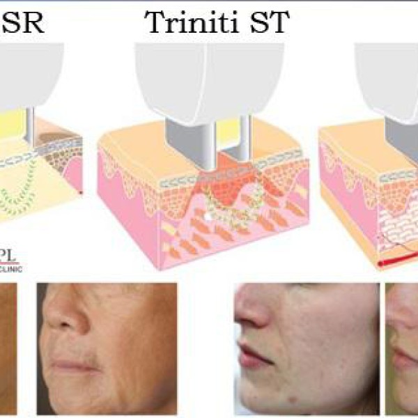 TRẺ HÓA DA, XÓA NẾP NHĂN BẰNG CÔNG NGHỆ ELOS