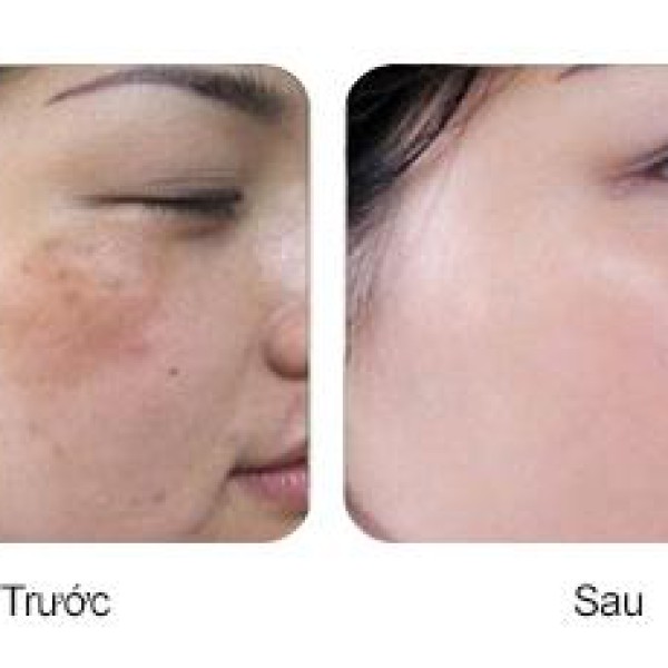 CÔNG NGHỆ RED PEEL