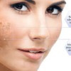 Điều trị nám, sạm, lão hóa, chảy xệ da, rụng tóc…