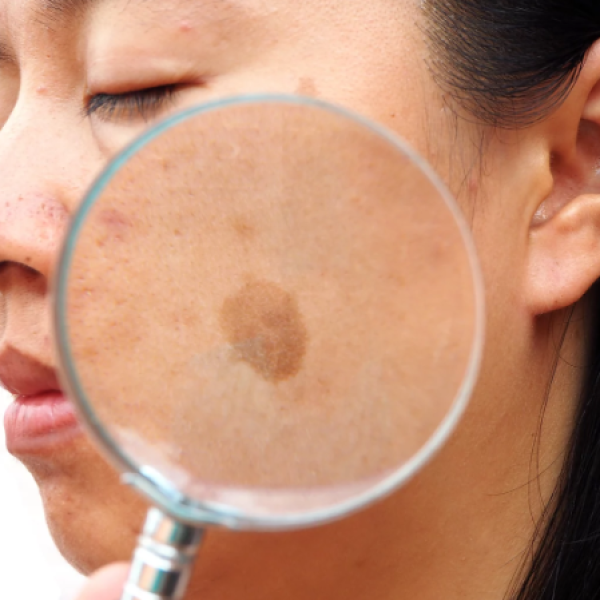 Tổng quan nghiên cứu tranexamic trong điều trị nám