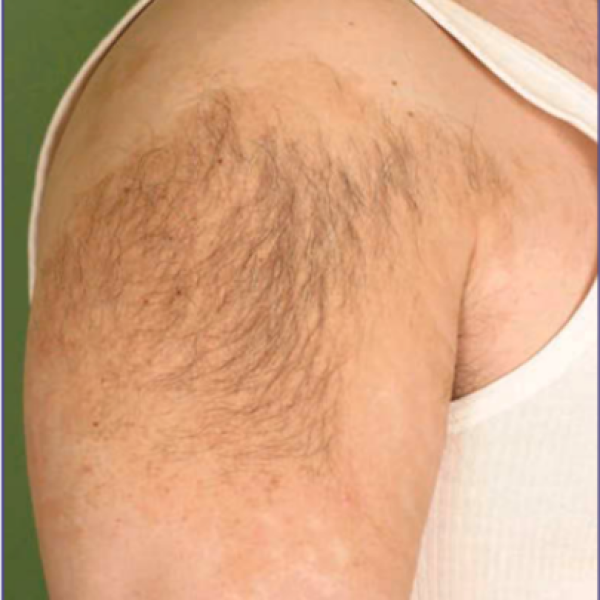 Nevus Becker ( Bớt Becker)