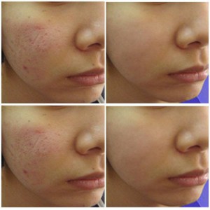 CÁC PHƯƠNG PHÁP ĐIỀU TRỊ SẸO