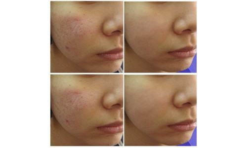 CÁC PHƯƠNG PHÁP ĐIỀU TRỊ SẸO