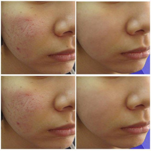 CÁC PHƯƠNG PHÁP ĐIỀU TRỊ SẸO